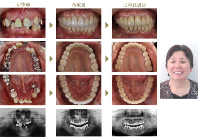 患者さんの声 インプラントは熊本市の添島歯科クリニック