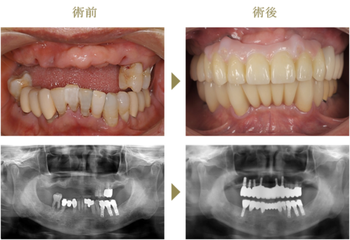 患者さんの声 インプラントは熊本市の添島歯科クリニック