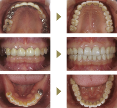 Case4 咬合治療(インプラント+補綴) (治療期間7ヶ月半)のイメージ