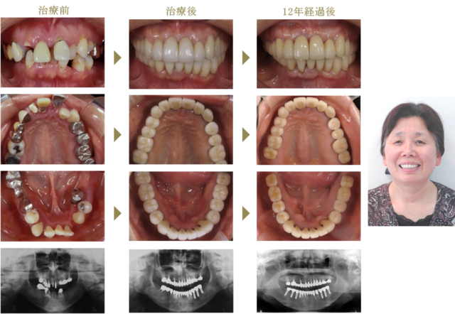 Case3 歯周病治療+矯正+インプラント+補綴 (治療期間3年)のイメージ