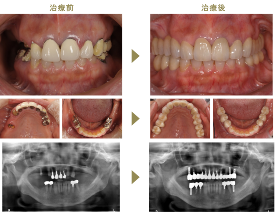 歯周治療＋インプラント＋補綴（治療期間1年3か月）